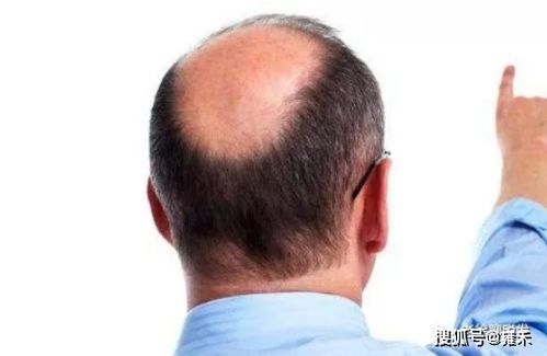 (植发有用吗,可以维持多久知乎)“植发有用吗 可以维持多久？了解植发手术效果及持久性”